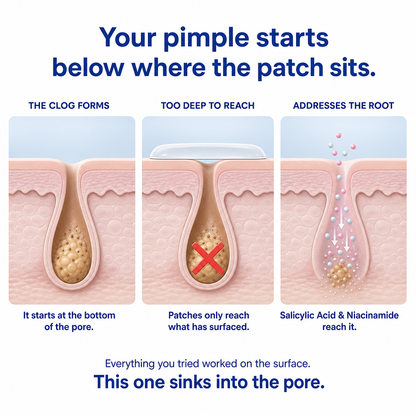 Acne Buster